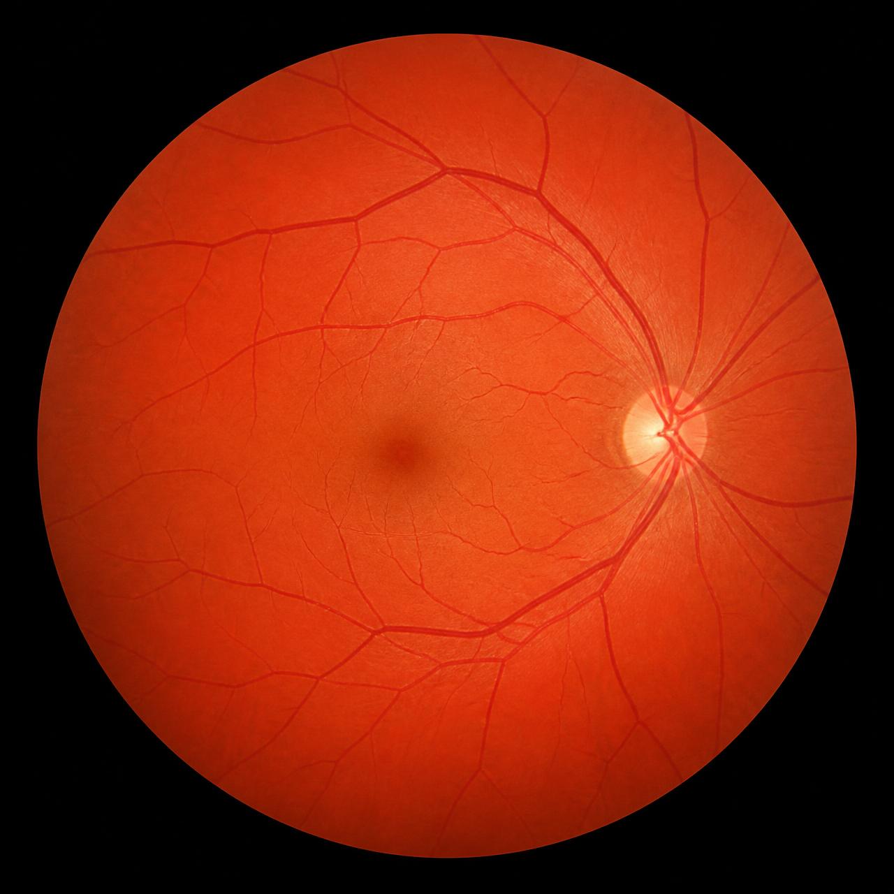 45° retinal fundus scan analyzed by Aireen AI for diabetic retinopathy, age-related macular degeneration and cardiovascular disease risk indicators.